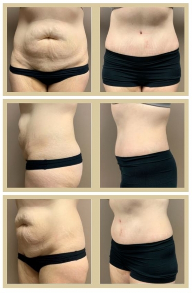 Liposuction vs. Tummy Tuck: Results, Pictures, Recovery, and Cost