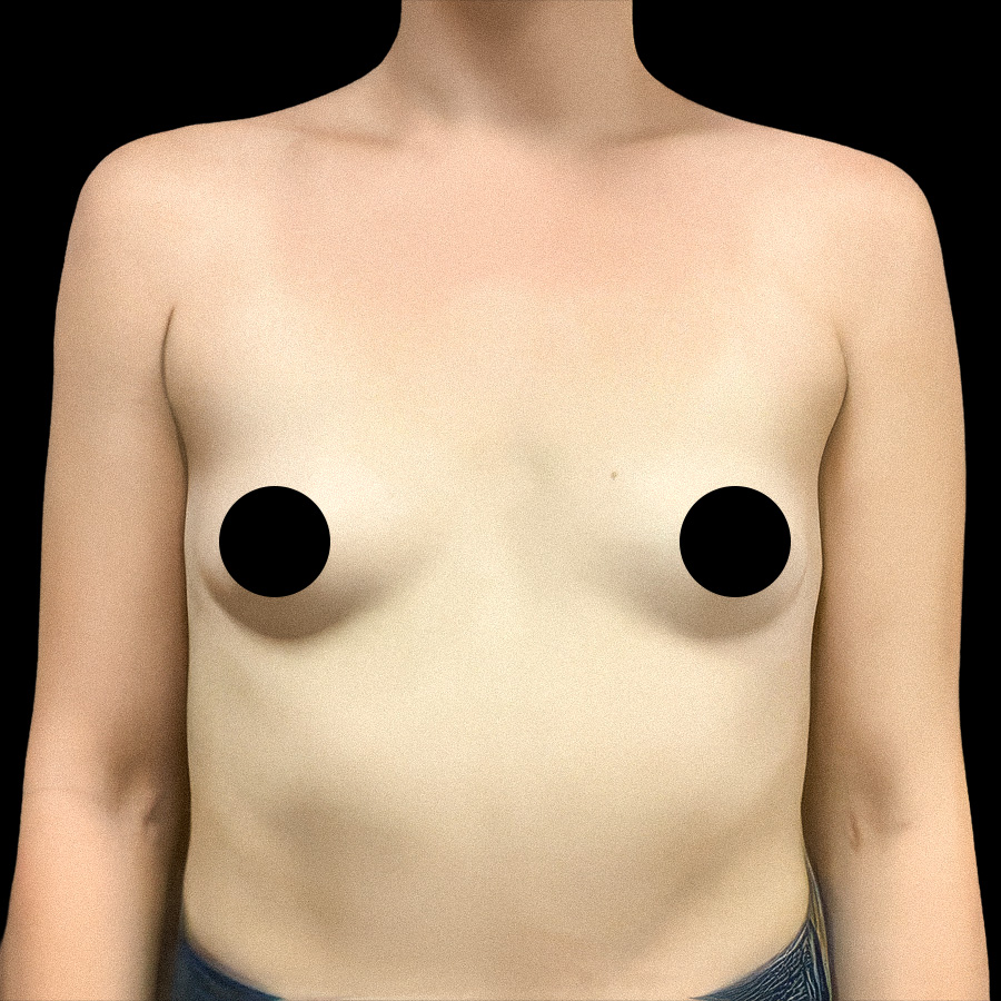 Before breast augmentation photo of a Scottsdale Plastics patient, front view