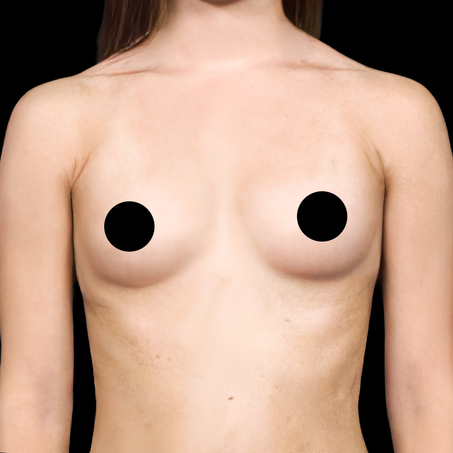 Before breast augmentation photo of a Scottsdale Plastics patient, front view