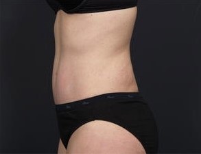 After Image: Tummy Tuck - left-side