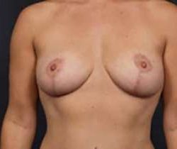 Breast Mastopexy Before & After Patient #115