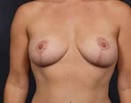 Breast Mastopexy Before & After Patient #115