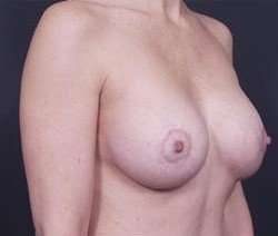 Breast Donut Mastopexy Before & After Patient #608