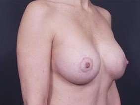 Breast Donut Mastopexy Before & After Patient #608