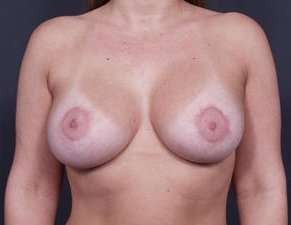Breast Donut Mastopexy Before & After Patient #615