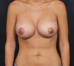 Breast Donut Mastopexy Before & After Patient #620