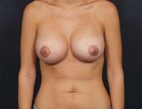 Breast Donut Mastopexy Before & After Patient #620