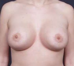 Breast Donut Mastopexy Before & After Patient #627