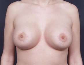 Breast Donut Mastopexy Before & After Patient #627