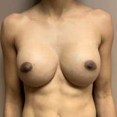Breast Augmentation Before & After Patient #661