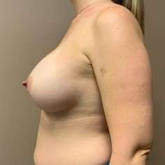 Breast Augmentation Before & After Patient #671