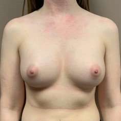 Breast Augmentation Before & After Patient #681