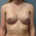 Breast Augmentation Before & After Patient #706
