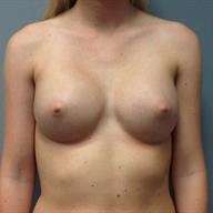 Breast Augmentation Before & After Patient #706