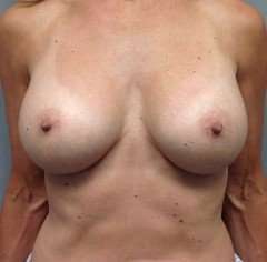 Breast Augmentation Before & After Patient #727