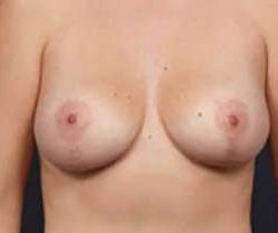 Breast Mastopexy Before & After Patient #126
