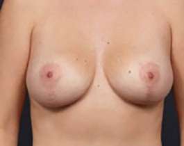 Breast Mastopexy Before & After Patient #126