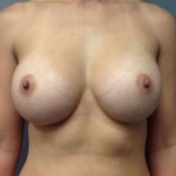 Breast Augmentation Before & After Patient #763