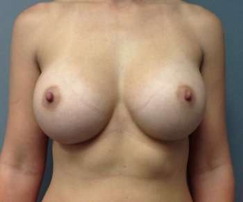 Breast Augmentation Before & After Patient #763