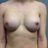 Breast Augmentation Before & After Patient #778
