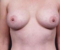 Breast Augmentation Before & After Patient #785