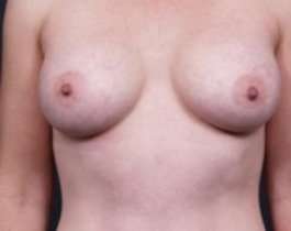 Breast Augmentation Before & After Patient #785