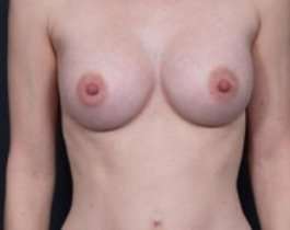 Breast Augmentation Before & After Patient #790