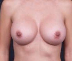 Breast Augmentation Before & After Patient #804