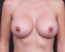 Breast Augmentation Before & After Patient #804