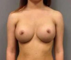 Breast Augmentation Before & After Patient #811