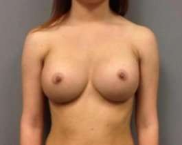 Breast Augmentation Before & After Patient #811