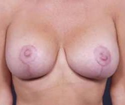 Breast Mastopexy Before & After Patient #131