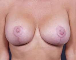 Breast Mastopexy Before & After Patient #131