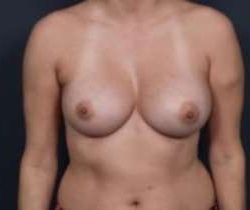 Breast Augmentation Before & After Patient #832