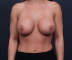 Breast Augmentation Before & After Patient #846