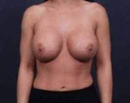 Breast Augmentation Before & After Patient #846