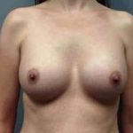 Breast Augmentation Before & After Patient #853