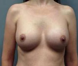 Breast Augmentation Before & After Patient #853