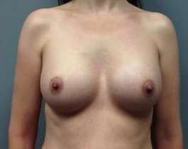 Breast Augmentation Before & After Patient #853