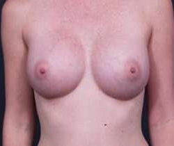 Breast Augmentation Before & After Patient #861