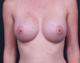 Breast Augmentation Before & After Patient #861