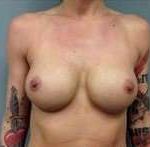 Breast Augmentation Before & After Patient #864