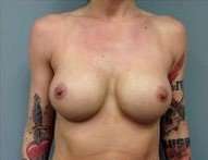 Breast Augmentation Before & After Patient #864