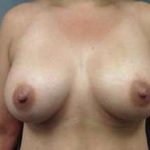 Breast Augmentation Before & After Patient #871