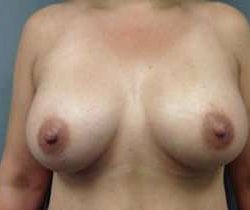 Breast Augmentation Before & After Patient #871