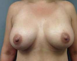 Breast Augmentation Before & After Patient #871