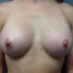 Breast Augmentation Before & After Patient #878