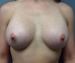 Breast Augmentation Before & After Patient #878