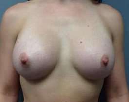 Breast Augmentation Before & After Patient #878