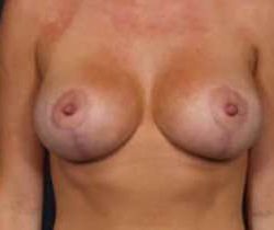 Breast Mastopexy Before & After Patient #136